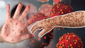 Four More Families Devastated by Measles: Death Toll Reaches 1,057, Cases Surpass 20,500